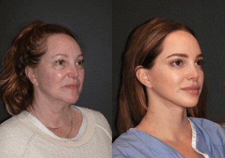 Comparison portraits of women's faces showing differences in skin tone and texture