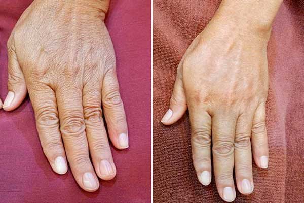 Comparison of the back of a hand before and after a period of skincare use